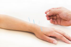 acupuncture leeds
